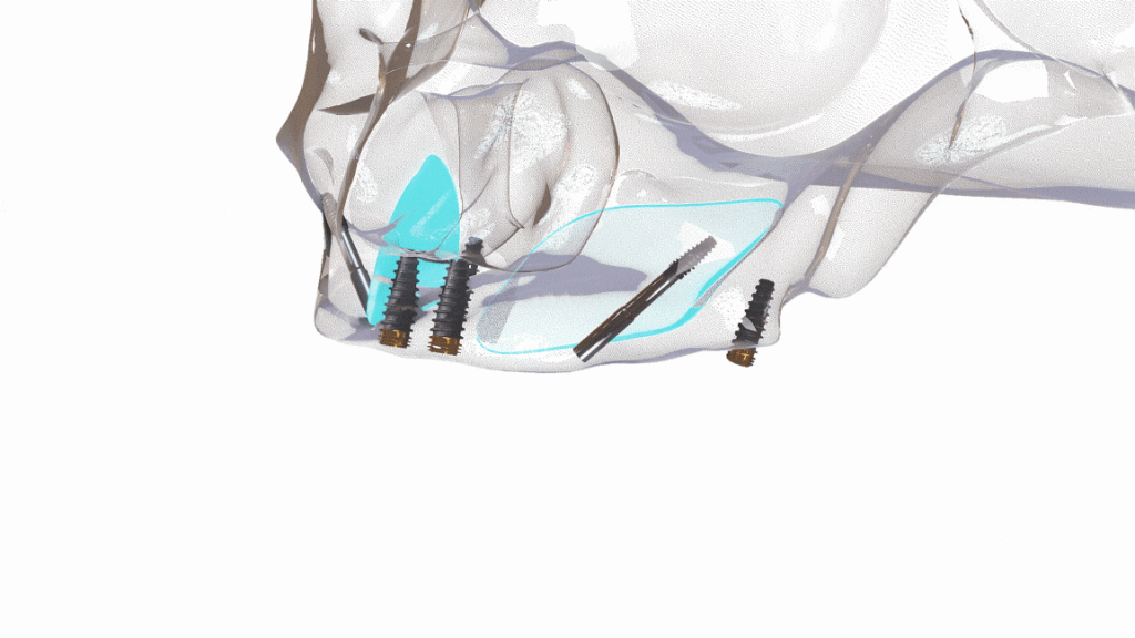 spot pubblicitario 3D dispositivo medico